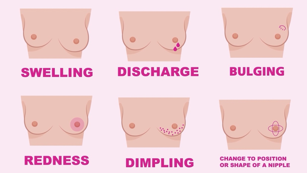 Swelling, discharge, bulging, redness, dimpling, change to the position or shape of a nipple.